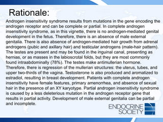 Rationale:
Androgen insensitivity syndrome results from mutations in the gene encoding the
androgen receptor and can be complete or partial. In complete androgen
insensitivity syndrome, as in this vignette, there is no androgen-mediated genital
development in the fetus. Therefore, there is an absence of male external
genitalia. There is also absence of androgen-mediated hair growth from adrenal
androgens (pubic and axillary hair) and testicular androgens (male-hair pattern).
The testes are present and may be found in the inguinal canal, presenting as
hernias, or as masses in the labioscrotal folds, but they are most commonly
found intraabdominally (78%). The testes make antimullerian hormone.
Therefore, there is regression of the mullerian structures: the uterus, tubes, and
upper two-thirds of the vagina. Testosterone is also produced and aromatized to
estradiol, resulting in breast development. Patients with complete androgen
insensitivity have female features, primary amenorrhea, and absence of sexual
hair in the presence of an XY karyotype. Partial androgen insensitivity syndrome
is caused by a less deleterious mutation in the androgen receptor gene that
results in partial activity. Development of male external genitalia can be partial
and incomplete.
 