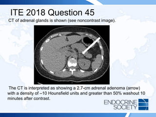 ITE 2018 Question 45
CT of adrenal glands is shown (see noncontrast image).
The CT is interpreted as showing a 2.7-cm adrenal adenoma (arrow)
with a density of –10 Hounsfield units and greater than 50% washout 10
minutes after contrast.
 