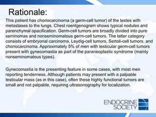 Rationale:
This patient has choriocarcinoma (a germ-cell tumor) of the testes with
metastases to the lungs. Chest roentgenogram shows typical nodules and
parenchymal opacification. Germ-cell tumors are broadly divided into pure
seminomas and nonseminomatous germ-cell tumors. The latter category
consists of embryonal carcinoma, Leydig-cell tumors, Sertoli-cell tumors, and
choriocarcinoma. Approximately 5% of men with testicular germ-cell tumors
present with gynecomastia as part of the paraneoplastic syndrome (mainly
nonseminomatous types).
Gynecomastia is the presenting feature in some cases, with most men
reporting tenderness. Although patients may present with a palpable
testicular mass (as in this case), often these highly functional tumors are
small and not palpable, requiring ultrasonography for localization.
 