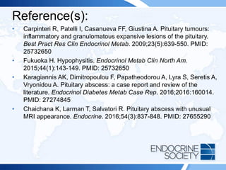Reference(s):
• Carpinteri R, Patelli I, Casanueva FF, Giustina A. Pituitary tumours:
inflammatory and granulomatous expansive lesions of the pituitary.
Best Pract Res Clin Endocrinol Metab. 2009;23(5):639-550. PMID:
25732650
• Fukuoka H. Hypophysitis. Endocrinol Metab Clin North Am.
2015;44(1):143-149. PMID: 25732650
• Karagiannis AK, Dimitropoulou F, Papatheodorou A, Lyra S, Seretis A,
Vryonidou A. Pituitary abscess: a case report and review of the
literature. Endocrinol Diabetes Metab Case Rep. 2016;2016:160014.
PMID: 27274845
• Chaichana K, Larman T, Salvatori R. Pituitary abscess with unusual
MRI appearance. Endocrine. 2016;54(3):837-848. PMID: 27655290
 