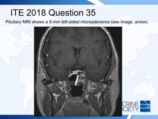 ITE 2018 Question 35
Pituitary MRI shows a 5-mm left-sided microadenoma (see image, arrow).
 