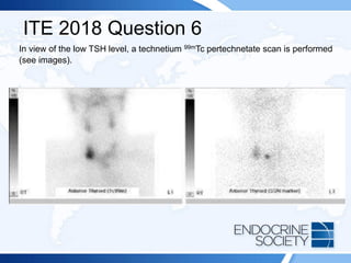 ITE 2018 Question 6
In view of the low TSH level, a technetium 99mTc pertechnetate scan is performed
(see images).
 