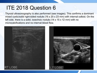 ITE 2018 Question 6
Thyroid ultrasonography is also performed (see images). This confirms a dominant
mixed cystic/solid right-sided nodule (16 x 20 x 23 mm) with internal colloid. On the
left side, there is a solid, isoechoic nodule (14 x 15 x 12 mm) with no
microcalcifications and no internal blood flow.
 