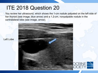 ITE 2018 Question 20
You review her ultrasound, which shows the 1-cm nodule palpated on the left side of
her thyroid (see image, blue arrow) and a 1.2-cm, nonpalpable nodule in the
contralateral lobe (see image, arrow).
Left Lobe
 