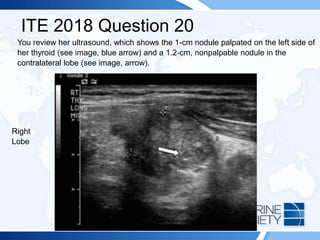 ITE 2018 Question 20
You review her ultrasound, which shows the 1-cm nodule palpated on the left side of
her thyroid (see image, blue arrow) and a 1.2-cm, nonpalpable nodule in the
contralateral lobe (see image, arrow).
Right
Lobe
 