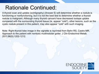Rationale Continued:
A thyroid scan and uptake (scintigraphy) (Answer E) will determine whether a nodule is
functioning or nonfunctioning, but it is not the best test to determine whether a thyroid
nodule is malignant. Although many thyroid cancers have decreased isotope uptake
compared with the surrounding thyroid tissue (ie, appear “cold”), other lesions, such as the
cystic nodule present in this patient, may also appear “cold” with such imaging.
Note: Right thyroid lobe image in the vignette is reprinted from Bahn RS, Castro MR.
Approach to the patient with nontoxic multinodular goiter. J Clin Endocrinol Metab.
2011;96(5):1202-1212.
 