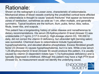 Rationale:
Shown on the radiograph is a Looser zone, characteristic of osteomalacia.
Mechanical stress of blood vessels overlying the uncalcified cortical bone affected
by osteomalacia is thought to cause “pseudo fractures” that appear as transverse
zones of rarefaction, sometimes as wide as 1 cm, often multiple, and generally
symmetric. Typical locations are the ischium, ilium, pubis, femur, tibia, radius,
fibula, lower ribs, and scapula.
This patient has a longstanding history of celiac disease and nonadherence to
dietary recommendations. His serum 25-hydroxyvitamin D level (Answer C) was
undetectable (<7 ng/mL [<17.5 nmol/L]). High-dosage vitamin D3, 100,000 IU
daily, did not correct the vitamin D deficiency, but ultraviolet light (tanning salon)
was successful. Chemical clues to osteomalacia include hypocalcemia,
hypophosphatemia, and elevated alkaline phosphatase. Excess fibroblast growth
factor 23 (Answer A) causes hypophosphatemia, but it is rare. While a low serum
1,25-dihydroxyvitamin D level (Answer B) would produce this pattern, it is usually
caused by vitamin D–dependent rickets type 1 (1α-hydroxylase deficiency) and is
typically diagnosed in childhood. Although this patient may have a high PTH level
(Answer D), its measurement would not identify the underlying cause.
 