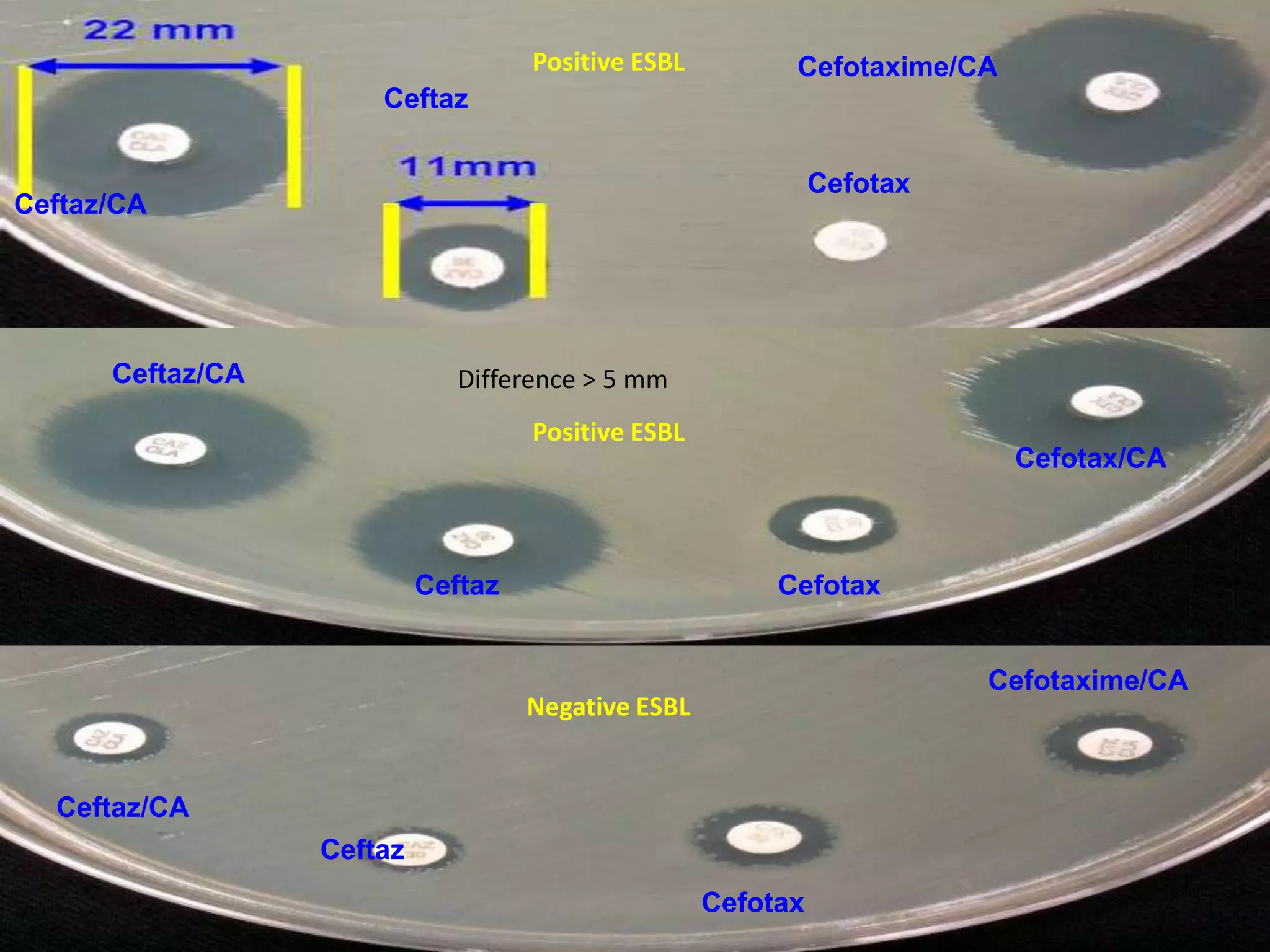 Positive ESBL

Cefotaxime/CA

Ceftaz
Cefotax

Ceftaz/CA

Ceftaz/CA

Difference > 5 mm
Positive ESBL

Ceftaz

Cefotax/CA

Cefotax
Cefotaxime/CA

Negative ESBL

Ceftaz/CA
Ceftaz
Cefotax

 
