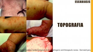 Escabiasis | PPTX