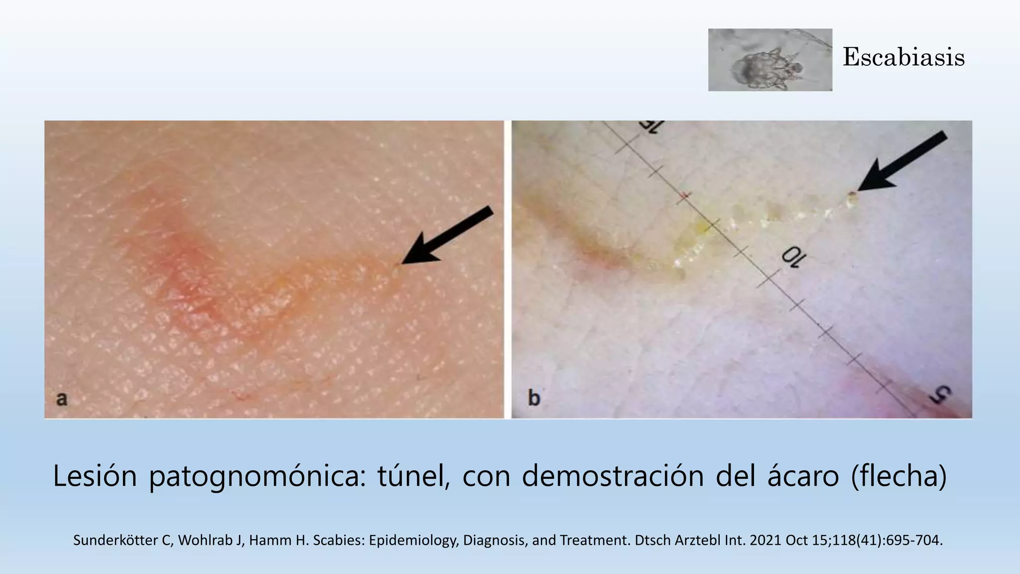 Escabiasis (Sarna) | PPTX | Infectious Diseases | Diseases and Conditions