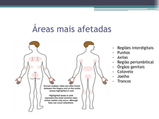 Áreas mais afetadas
- Regiões interdigitais
- Punhos
- Axilas
- Região periumbilical
- Órgãos genitais
- Cotovelo
- Joelho
- Troncos
 
