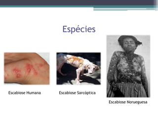 Espécies
Escabiose Humana Escabiose Sarcóptica
Escabiose Norueguesa
 