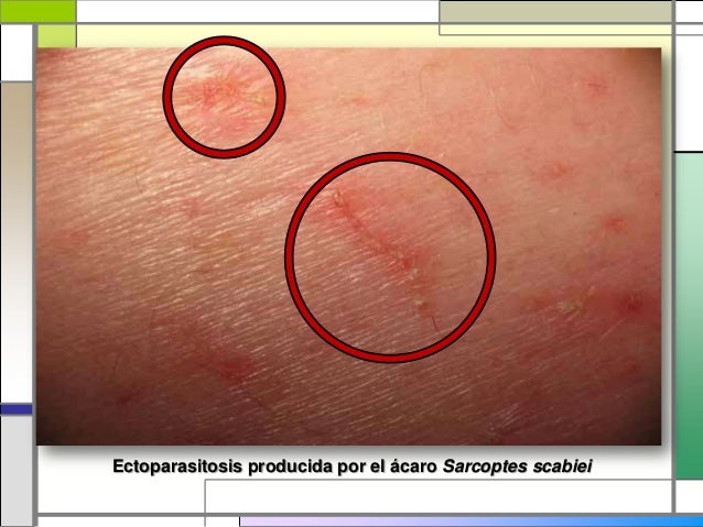 escabiosis-dermatolog-a