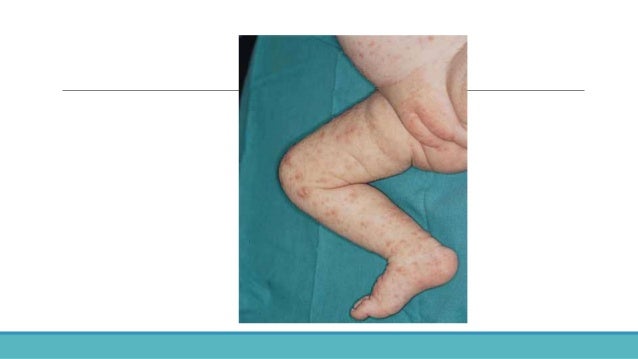 Atopichesky la dermatitis al niño los síntomas