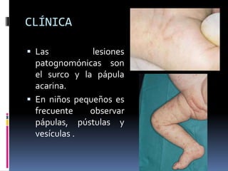 CLÍNICA
 Las lesiones
patognomónicas son
el surco y la pápula
acarina.
 En niños pequeños es
frecuente observar
pápulas, pústulas y
vesículas .
 