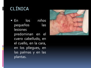 CLÍNICA
 En los niños
pequeños las
lesiones
predominan en el
cuero cabelludo, en
el cuello, en la cara,
en los pliegues, en
las palmas y en las
plantas.
 