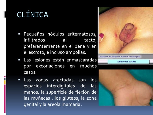 Escabiosis O Sarna En Pediatria