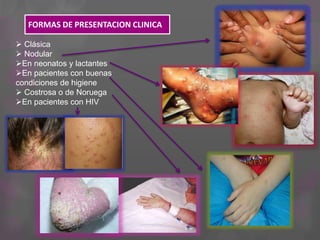 FORMAS DE PRESENTACION CLINICA
 Clásica
 Nodular
En neonatos y lactantes
En pacientes con buenas
condiciones de higiene
 Costrosa o de Noruega
En pacientes con HIV
 