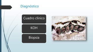 Diagnóstico
Cuadro clínico
KOH
Biopsia
 