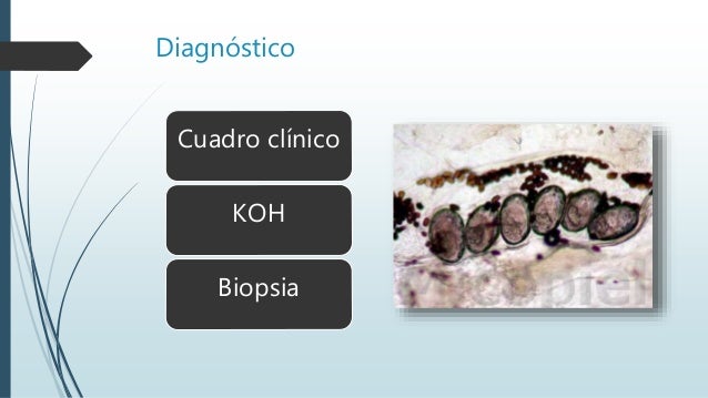 La psoriasis nuevo en el tratamiento 2014