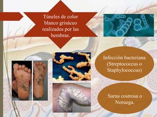 Infección bacteriana
(Streptococcus o
Staphylococcus)
Sarna costrosa o
Noruega.
Túneles de color
blanco grisáceo
realizados por las
hembras.
 