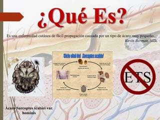 Es una enfermedad cutánea de fácil propagación causada por un tipo de ácaro muy pequeño.
Kevin Berman, MD.
Ácaro Sarcoptes scabiei var.
hominis
ETS
 