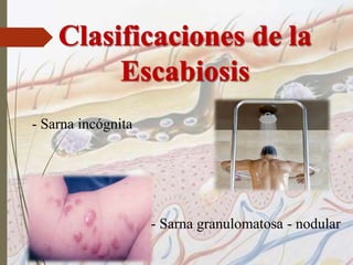 - Sarna incógnita
- Sarna granulomatosa - nodular
 