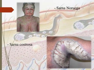 - Sarna costrosa
- Sarna Noruega
 