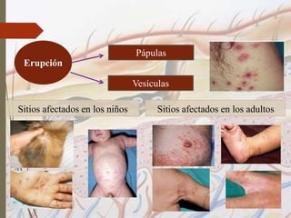 Erupción
Pápulas
Vesículas
Sitios afectados en los niños Sitios afectados en los adultos
 