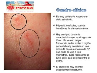 Es muy polimorfo. Aspecto en
cielo estrellado.
Pápulas, vesículas, costras
hemáticas fundamentalmente.
Hay un signo bastante
característico que es el signo del
túnel. Se ve con mayor
frecuencia en las axilas o región
periumbilical y consiste en una
diminuta costra en forma de "S"
que mide de uno a tres
milímetros. Esto representa el
túnel en el cual se encuentra el
ácaro.
El prurito es muy intenso
especialmente nocturno.
 