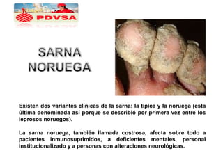 Existen dos variantes clínicas de la sarna: la típica y la noruega (esta
última denominada así porque se describió por primera vez entre los
leprosos noruegos).
La sarna noruega, también llamada costrosa, afecta sobre todo a
pacientes inmunosuprimidos, a deficientes mentales, personal
institucionalizado y a personas con alteraciones neurológicas.
 