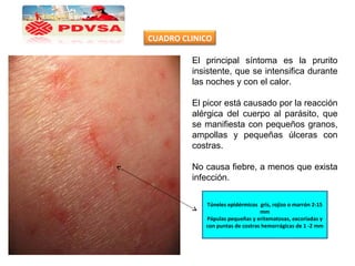 El principal síntoma es la prurito
insistente, que se intensifica durante
las noches y con el calor.
El picor está causado por la reacción
alérgica del cuerpo al parásito, que
se manifiesta con pequeños granos,
ampollas y pequeñas úlceras con
costras.
No causa fiebre, a menos que exista
infección.
Túneles epidérmicos gris, rojizo o marrón 2-15
mm
Pápulas pequeñas y eritematosas, excoriadas y
con puntas de costras hemorrágicas de 1 -2 mm
CUADRO CLINICO
 