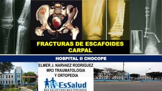 FRACTURAS DE ESCAFOIDES
CARPAL
ELMER J. NARVAEZ RODRIGUEZ
MR3 TRAUMATOLOGIA
Y ORTOPEDIA
 