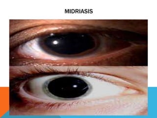 MIDRIASIS
 