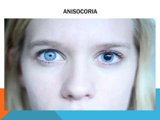 ANISOCORIA
 