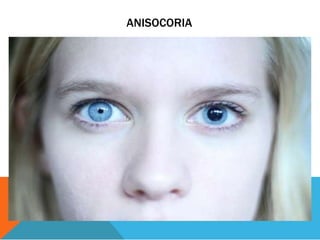 ANISOCORIA
 