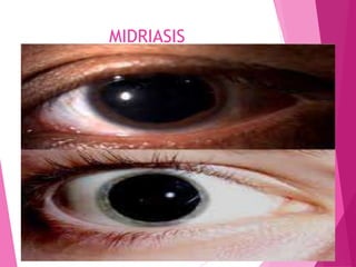 MIDRIASIS
 