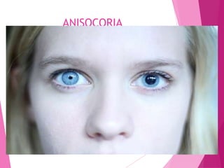 ANISOCORIA
 