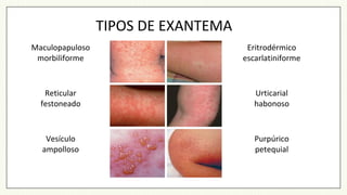 TIPOS DE EXANTEMA
Maculopapuloso
morbiliforme
Reticular
festoneado
Vesículo
ampolloso
Eritrodérmico
escarlatiniforme
Urticarial
habonoso
Purpúrico
petequial
 