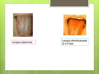 Lengua saburrosa
Lengua aframbuesada
(4 o 5 dia)
 