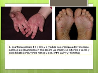 El exantema persiste 4 ó 5 días y a medida que empieza a desvanecerse
aparece la descamación en cara (sobre las orejas), se extiende a tronco y
extremidades (incluyendo manos y pies, entre la 2ª y 3ª semana).
 