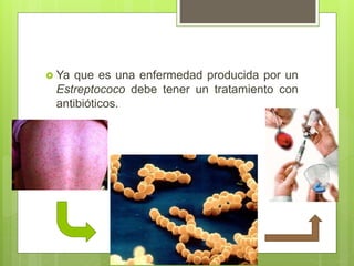  Ya que es una enfermedad producida por un
Estreptococo debe tener un tratamiento con
antibióticos.
 