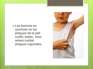  Las lesiones se
acentúan en los
pliegues de la piel:
cuello, axilas, fosa
antero cubital,
pliegues inguinales.
 