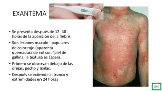 EXANTEMA
• Se presenta después de 12- 48
horas de la aparición de la fiebre
• Son lesiones maculo - papulares
de color rojo (aparenta
quemadura de sol con “piel de
gallina, la textura es áspera.
• Primero se observan debajo de las
orejas, pecho y axilas.
• Después se extiende al tronco y
extremidades en 24 horas
GPC
 