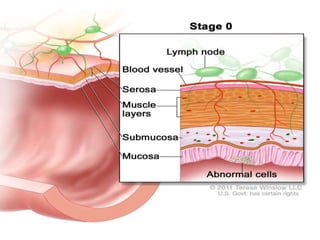 Escc esophageal squamous cell carcinoma | PPTX