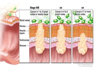 Escc esophageal squamous cell carcinoma | PPTX