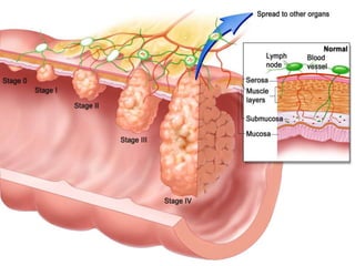 Escc esophageal squamous cell carcinoma | PPTX