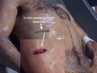 Lesión punzo cortante 
suturada 
 