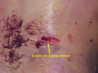 Lesión en región dorsal 
 
