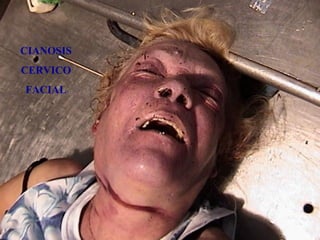 CIANOSIS 
CERVICO 
FACIAL 
 